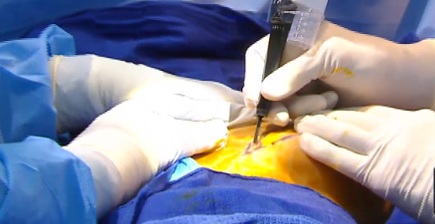Global Surgical Lasers Market To Hit USD 3 Billion By 2024